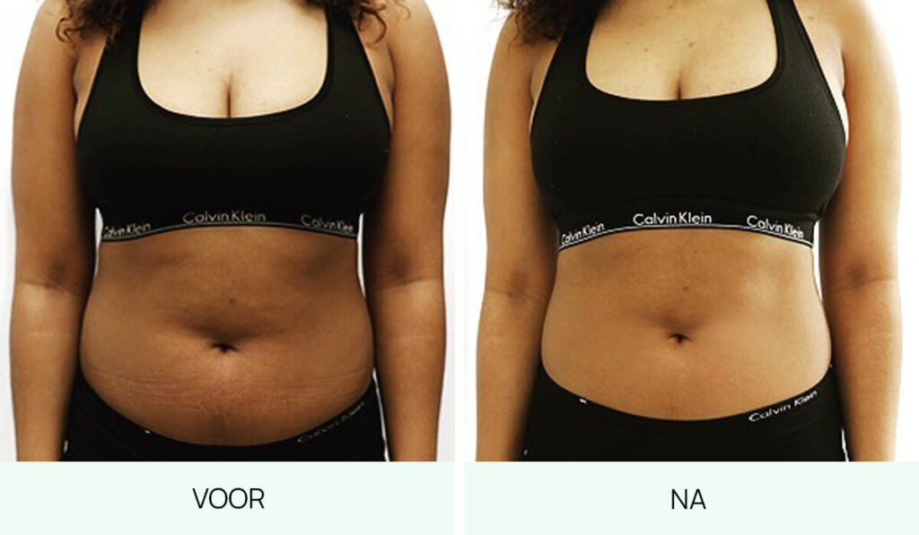 CRYOSKIN voor-na